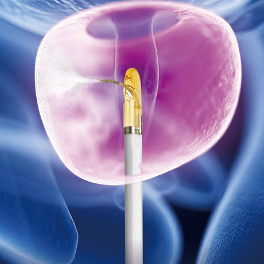 Illustration of Rezum water vapor therapy