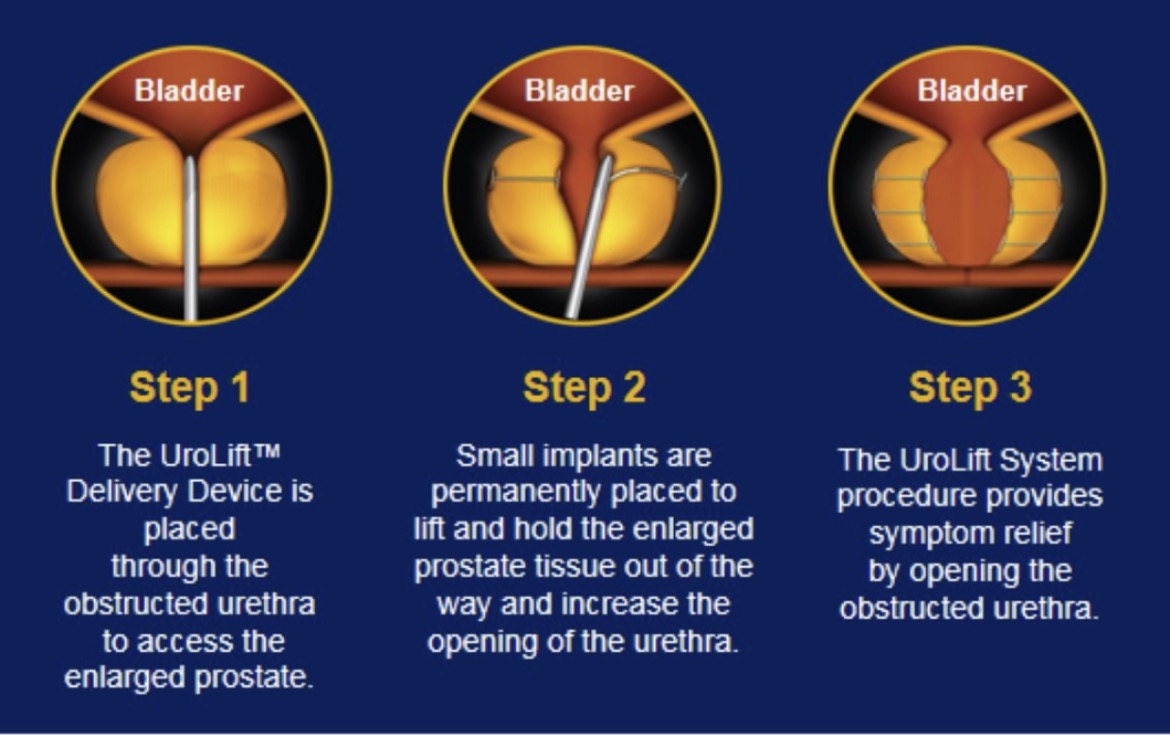 Illustration of the UroLift procedure